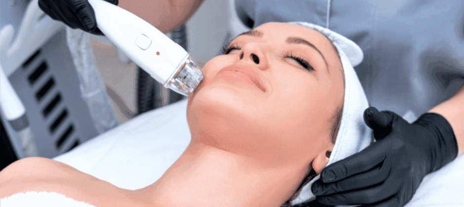 laser-acne-treatmen