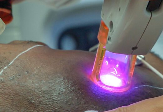 laser hair